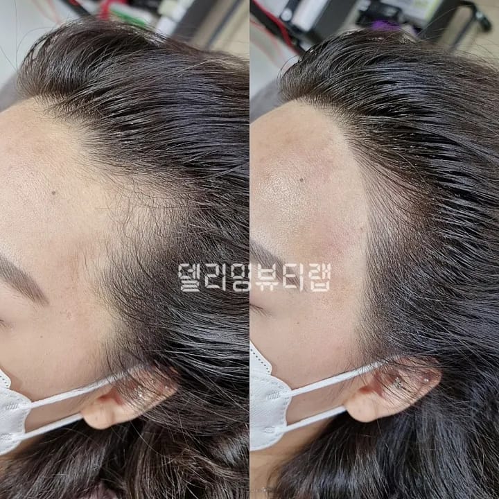 헤어라인 엠보
