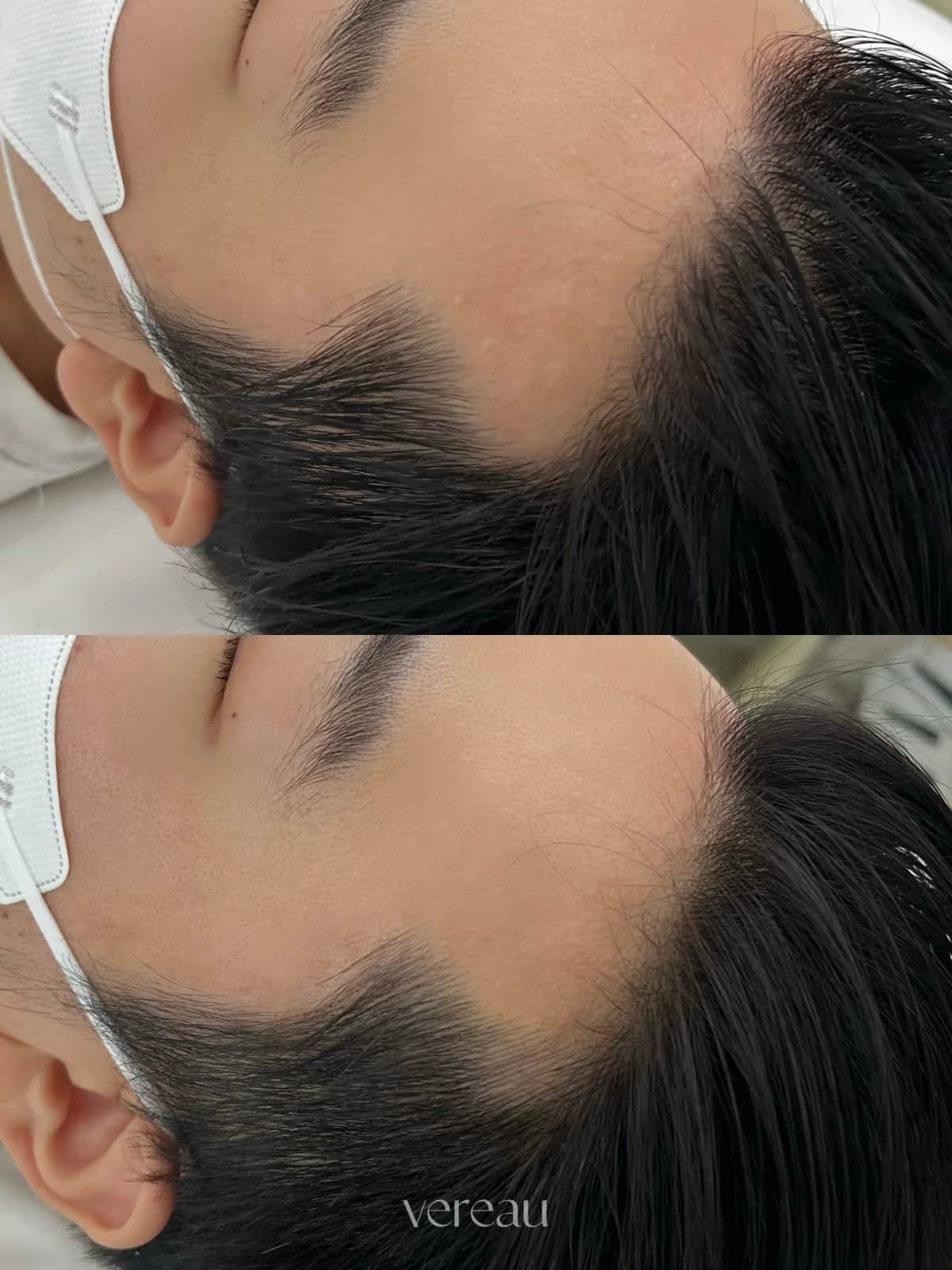 남성 M자 헤어라인