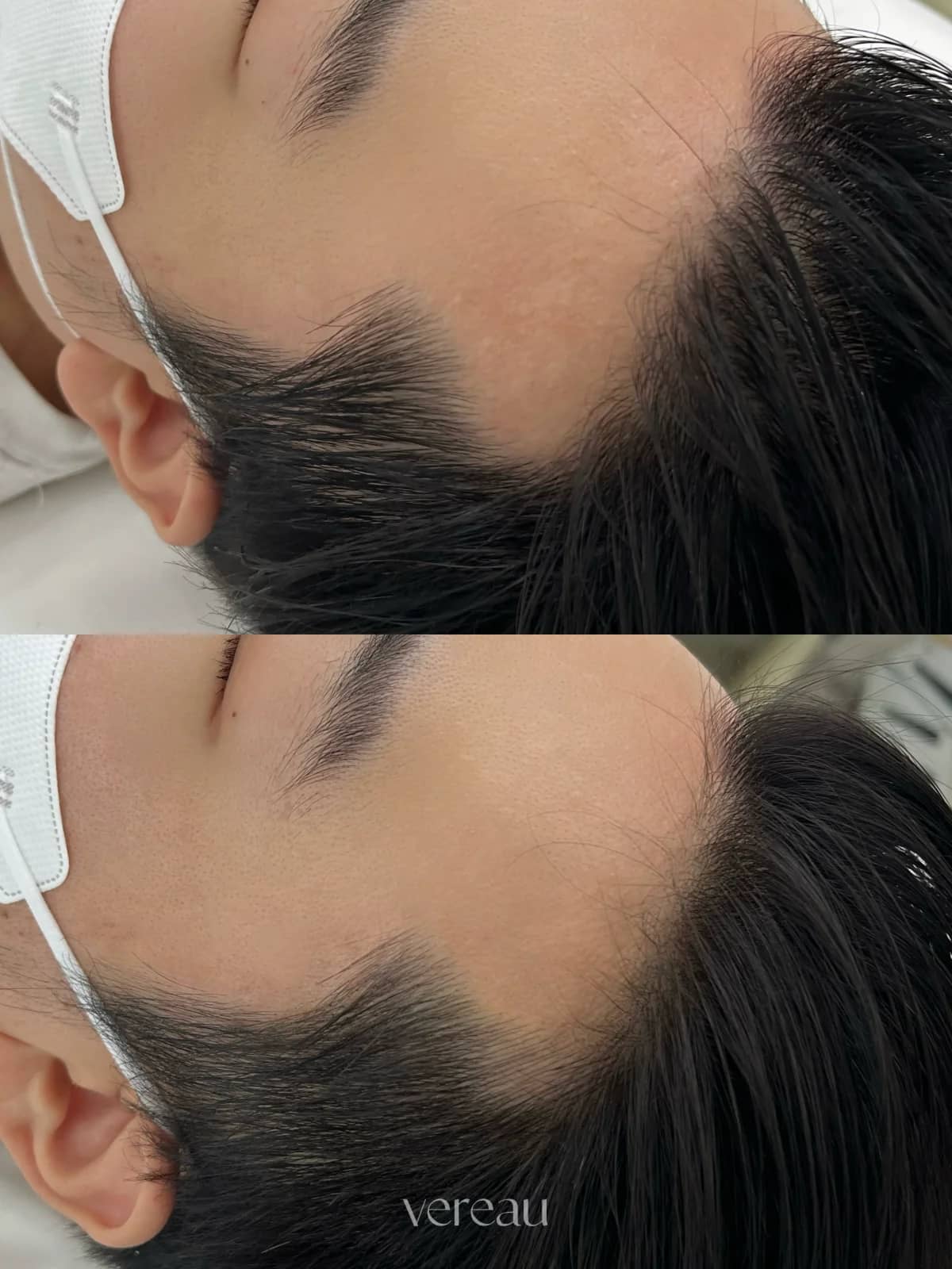 남성 M자 헤어라인