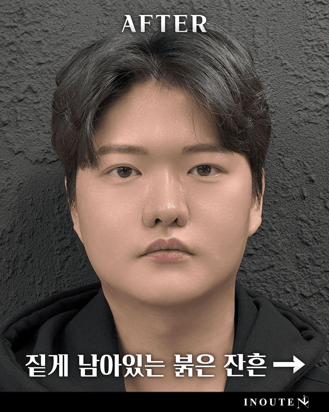 잔흔 커버(붉은색 및 얼룩)