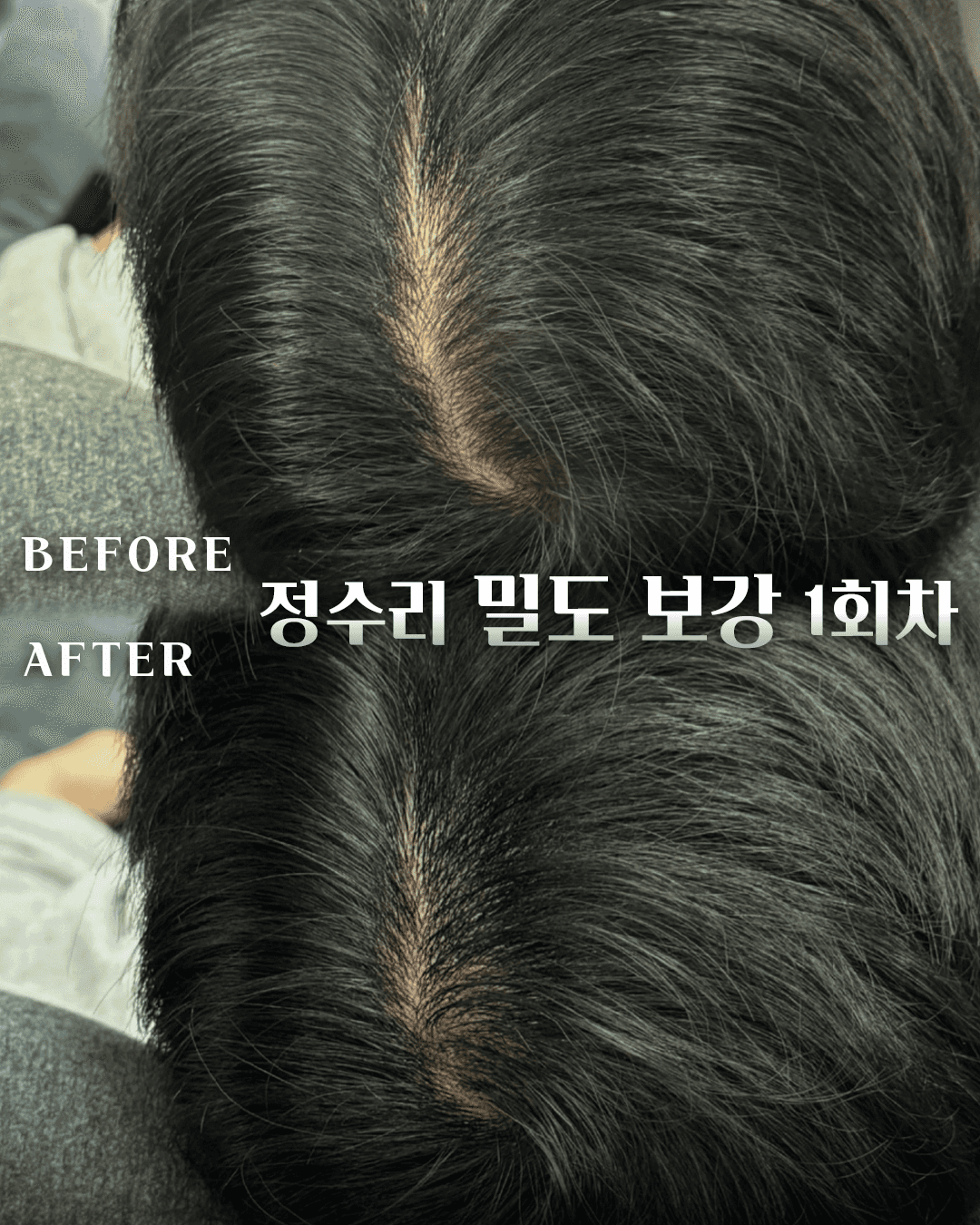 남성전문 정수리 커버(1회차)