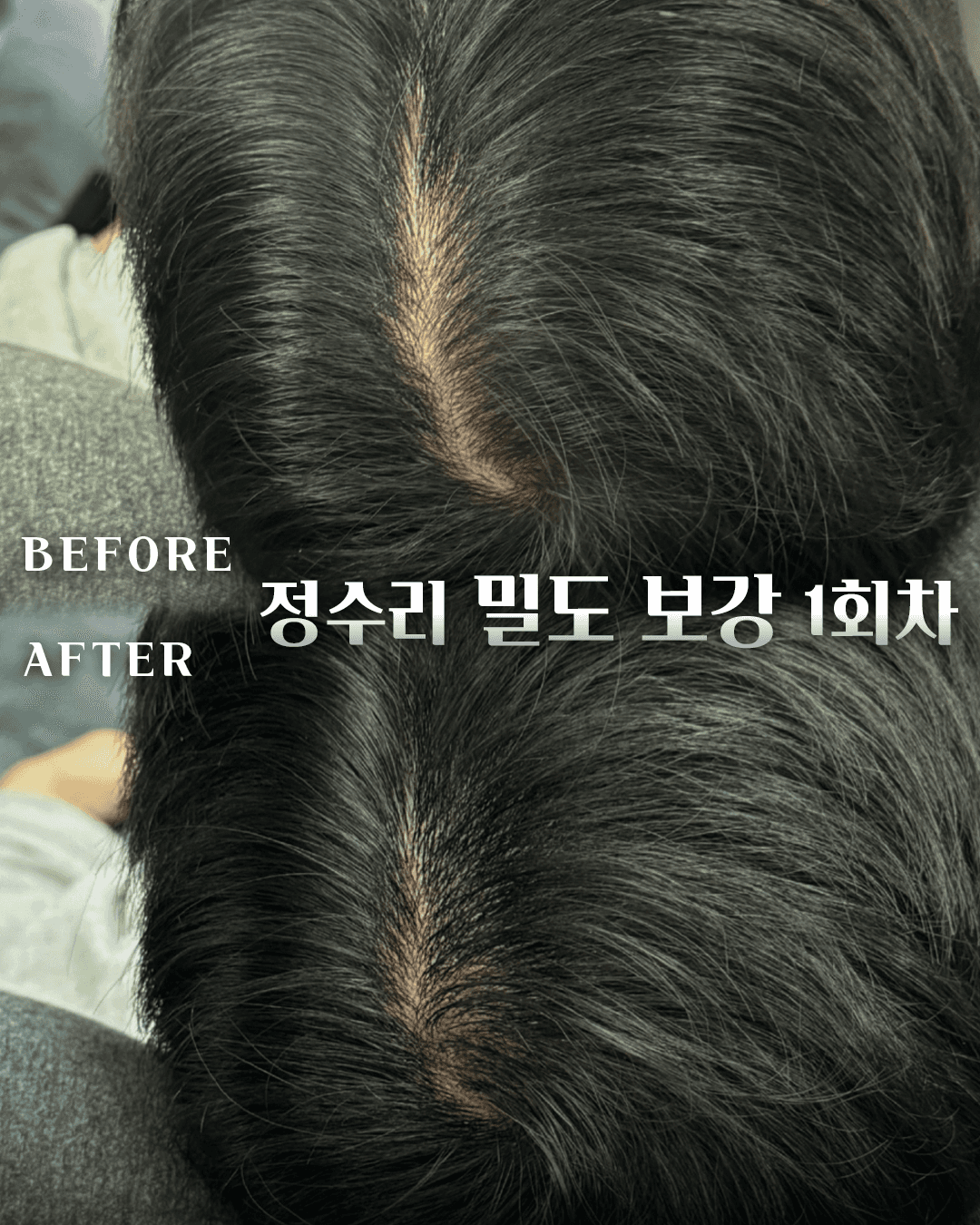 남성전문 정수리 커버(1회차)