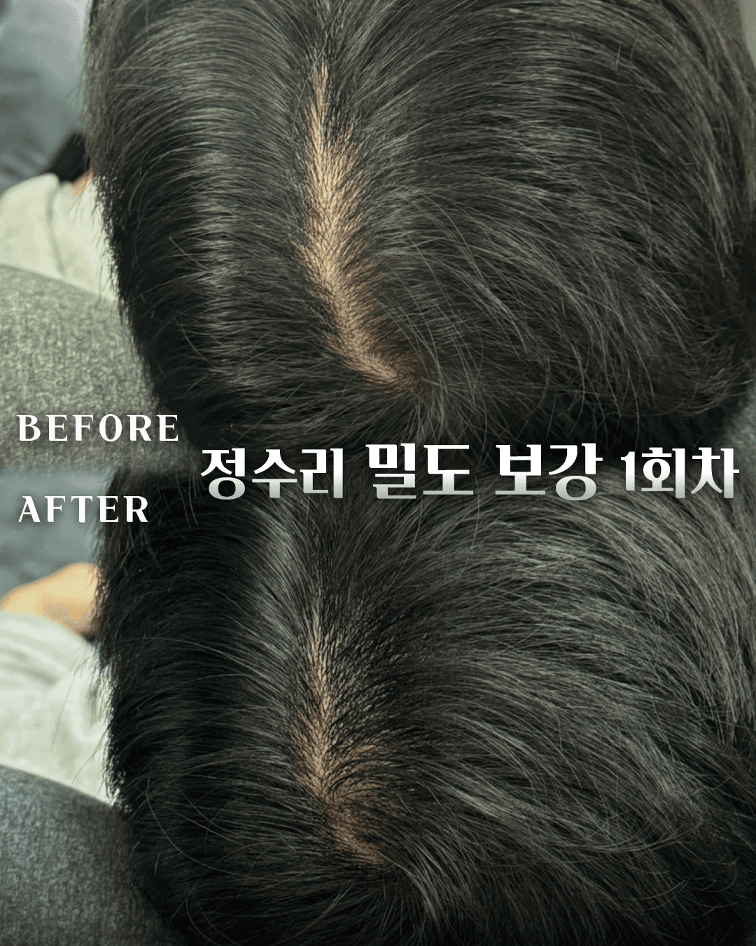 남성전문 정수리 커버(1회차)