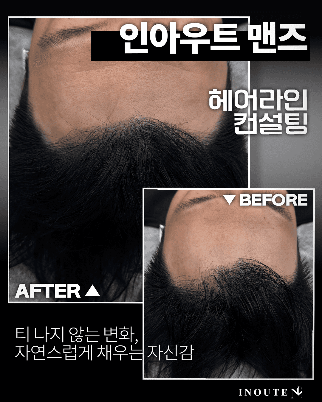 남성전문 헤어라인 커버(M자)