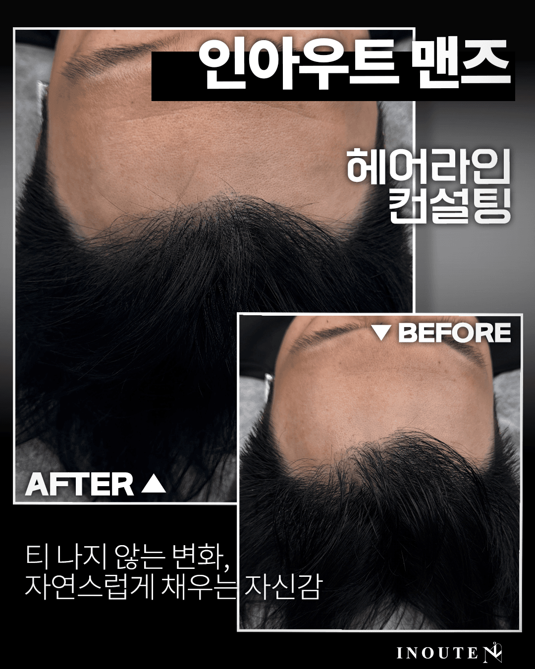 남성전문 헤어라인 커버(M자)