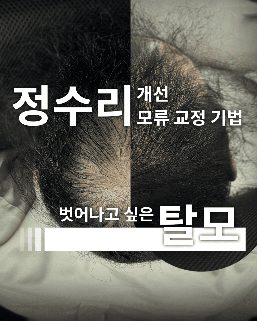정수리 전체 밀도보강(5회)