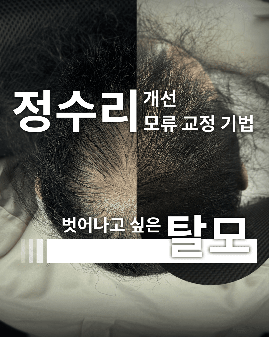 정수리 전체 밀도보강(5회)