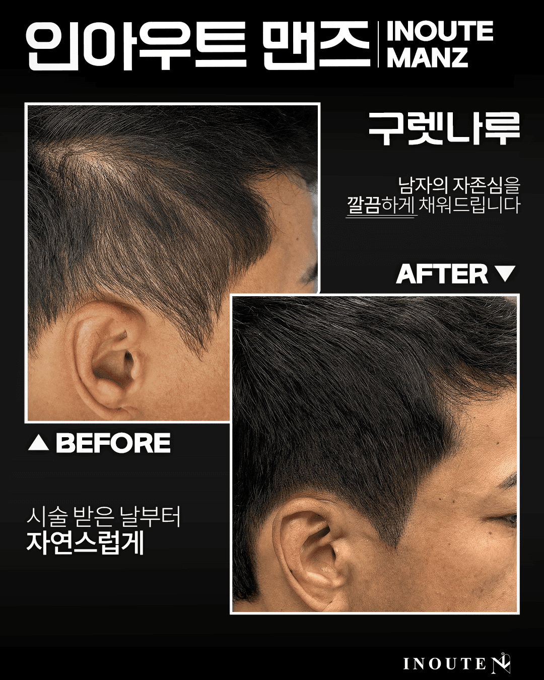 남자 사이드/구렛나루 밀도보강(3회)