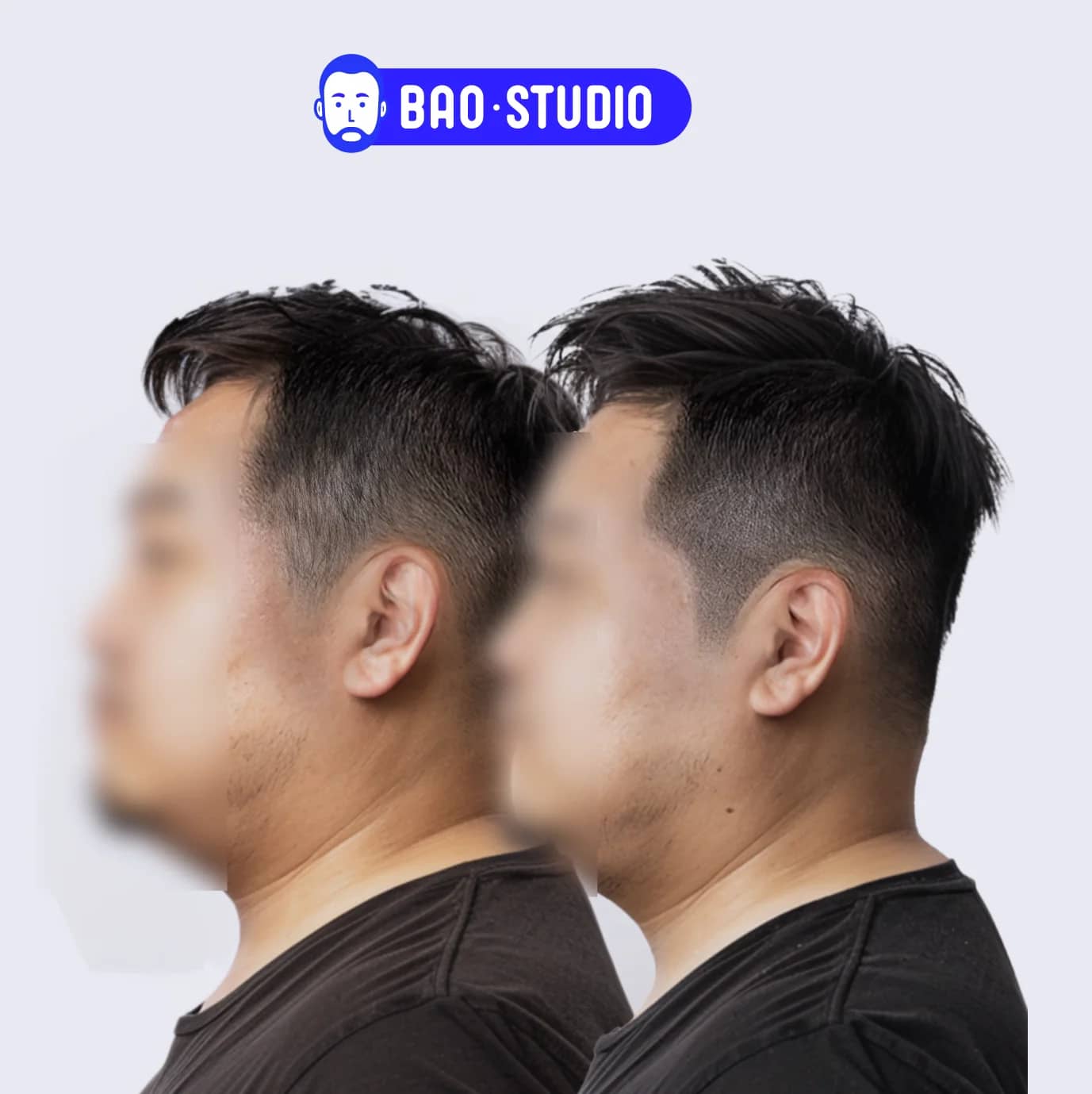 옆머리 밀도 보강 SMP | 자연스러운 사이드 커버