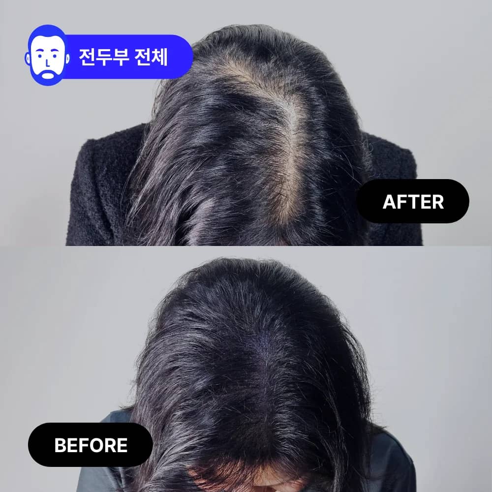 여성 정수리 SMP | 전두부 밀도 보강