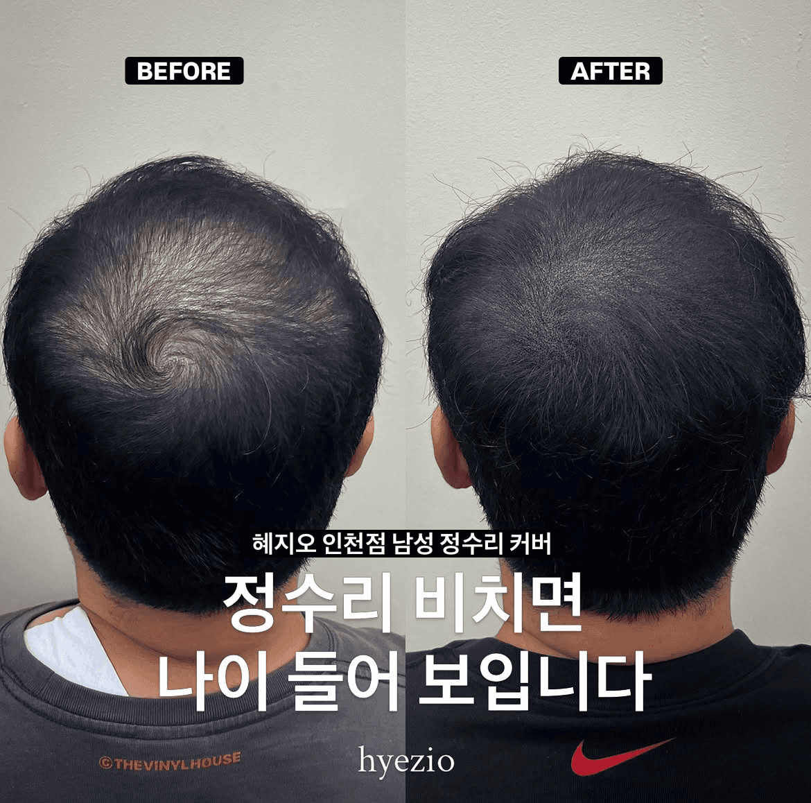 남성 정수리 두피문신 SMP