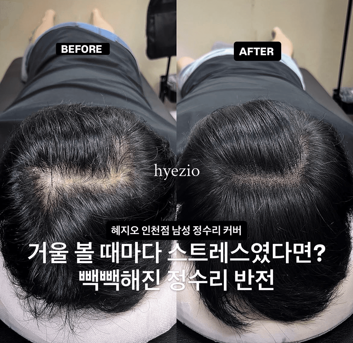 남성 정수리 두피문신