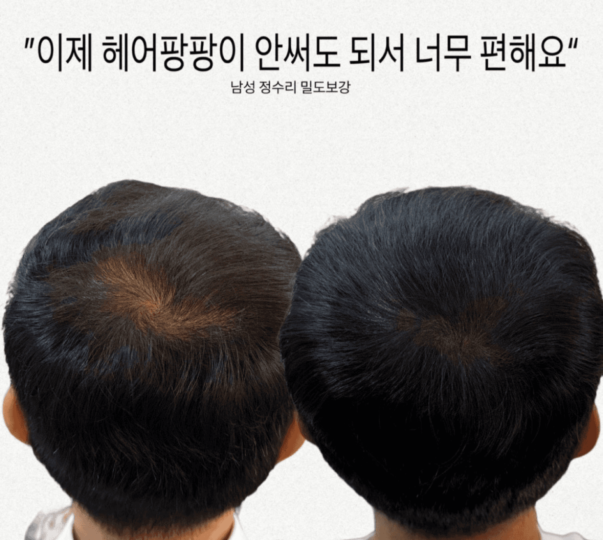 남자 정수리 숱채움