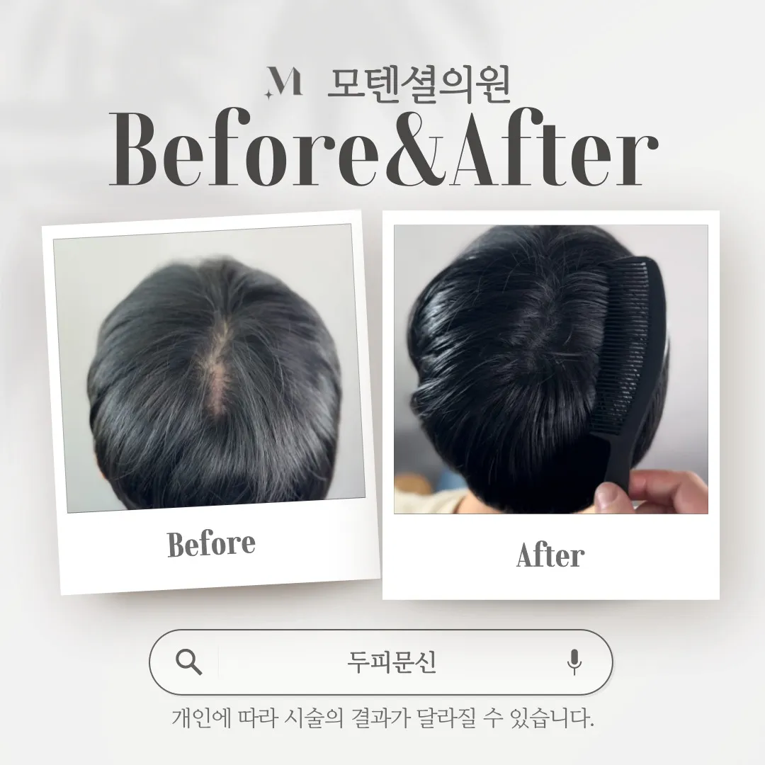 남자 smp 두피문신