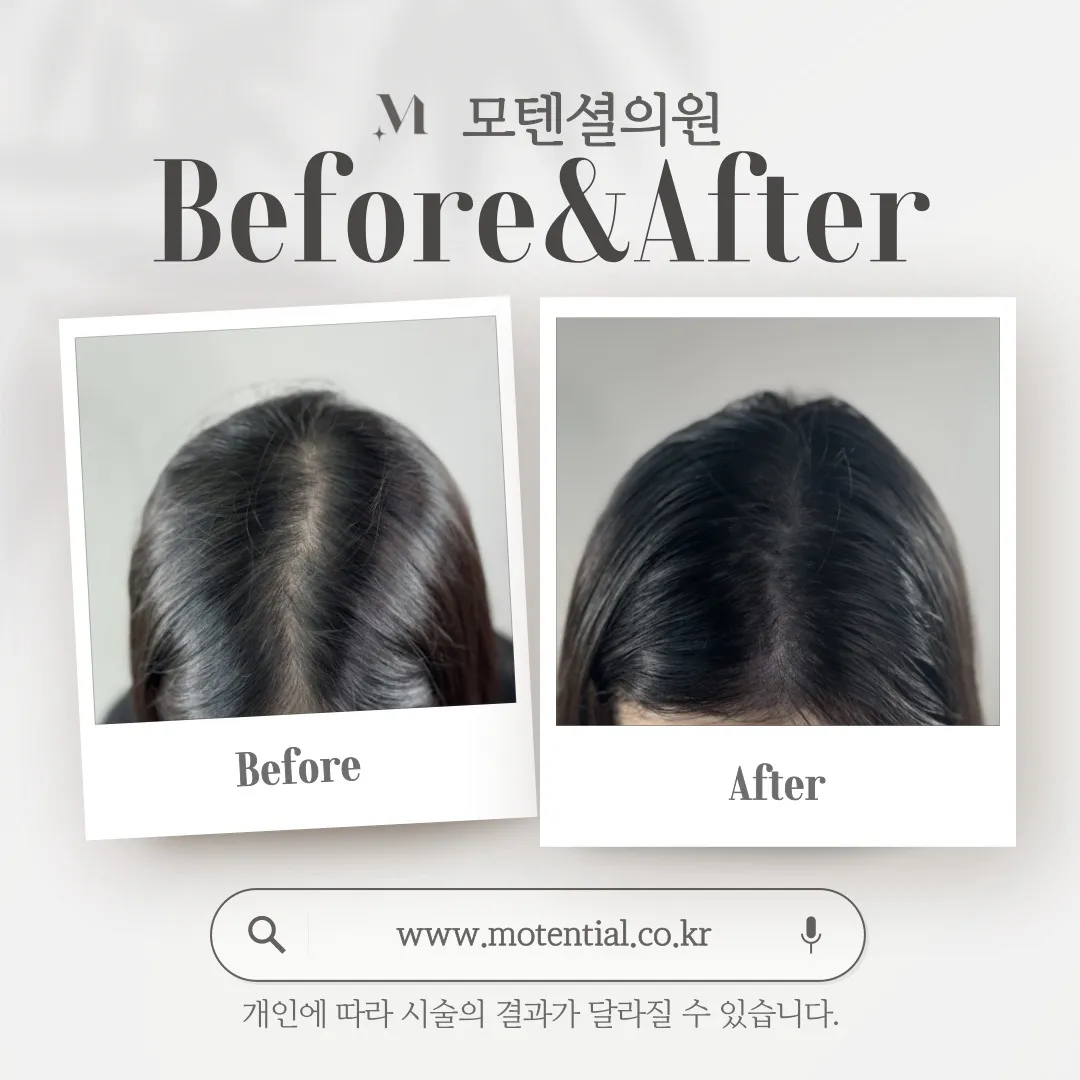 여자 두피문신