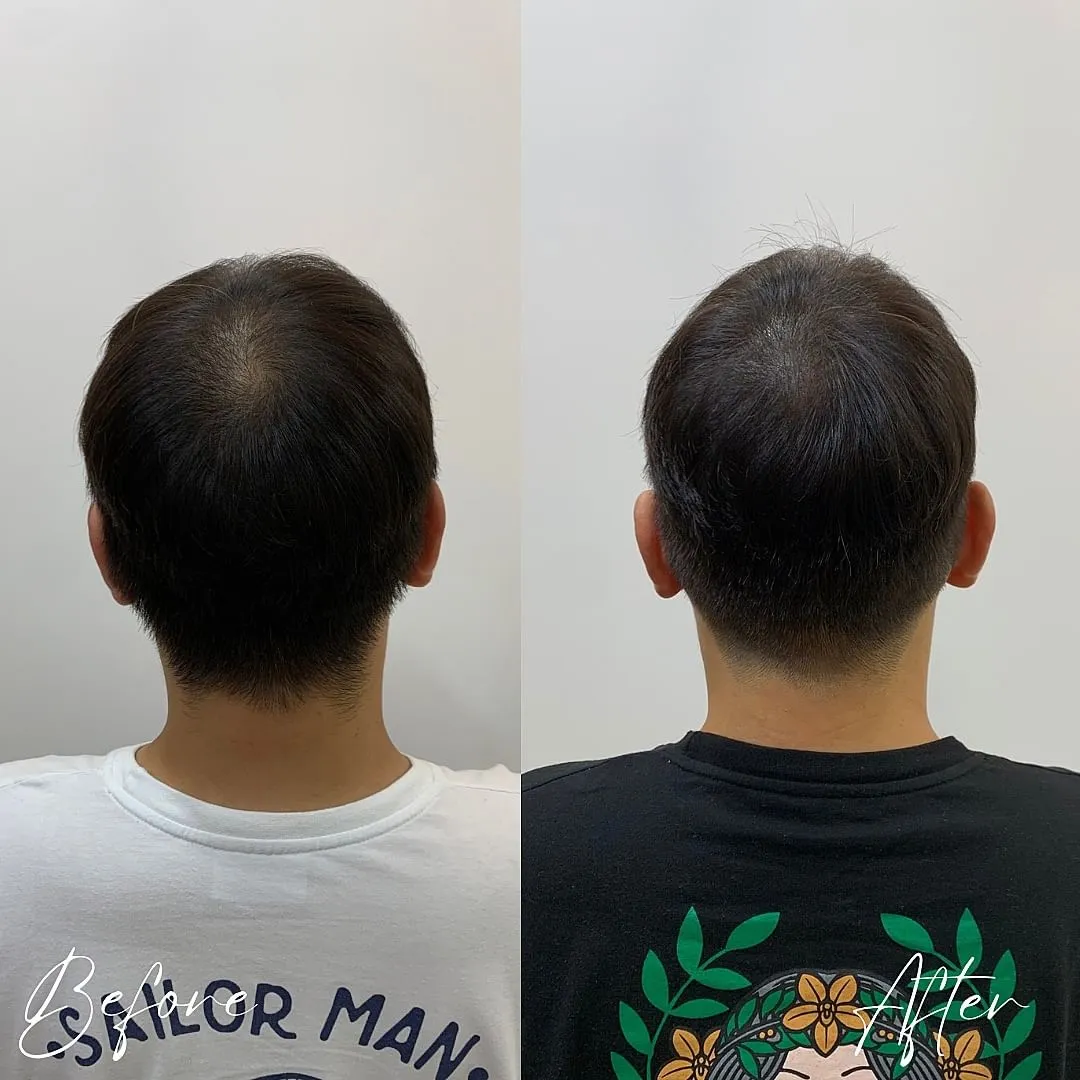 남성정수리) 두피문신 SMP