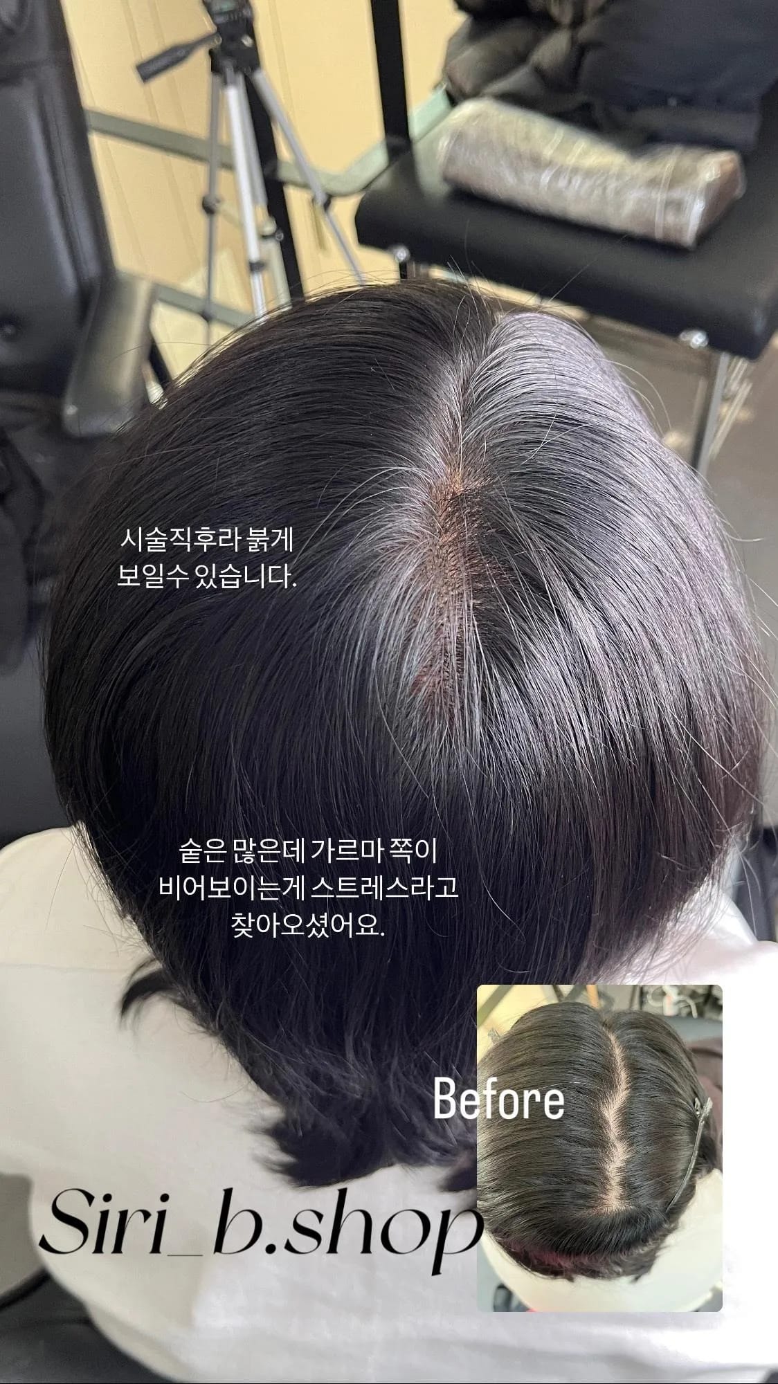 정수리(smp)
