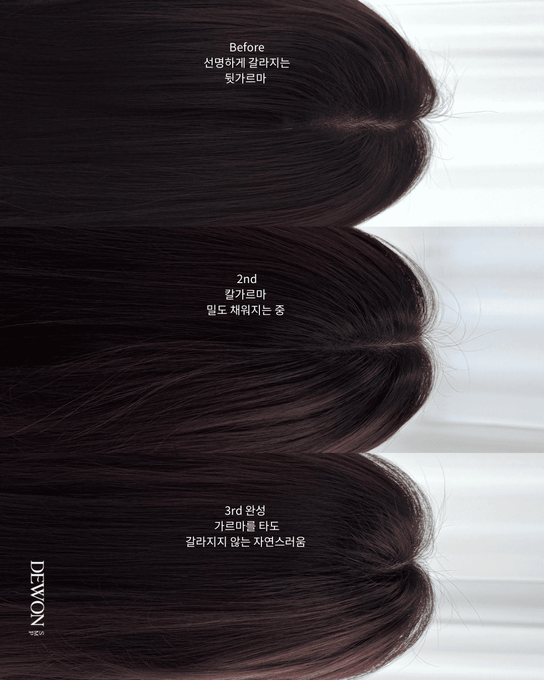 휑한 정수리 밀도 보완 SMP