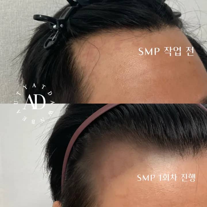 M자 탈모 진행 중, 채우기