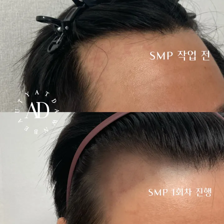 M자 탈모 진행 중, 채우기