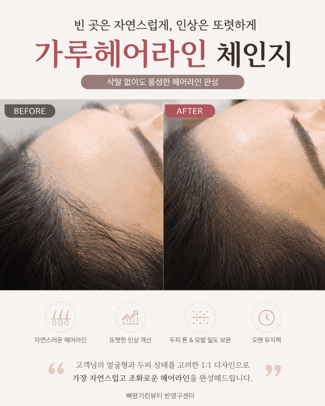 M자 가루헤어라인으로 커버 🤎