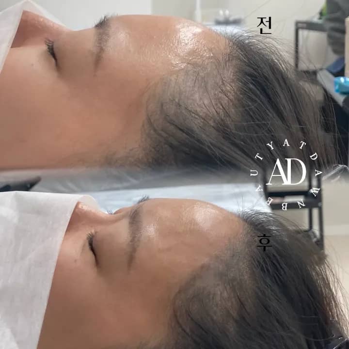 잔흔 덮어버리기