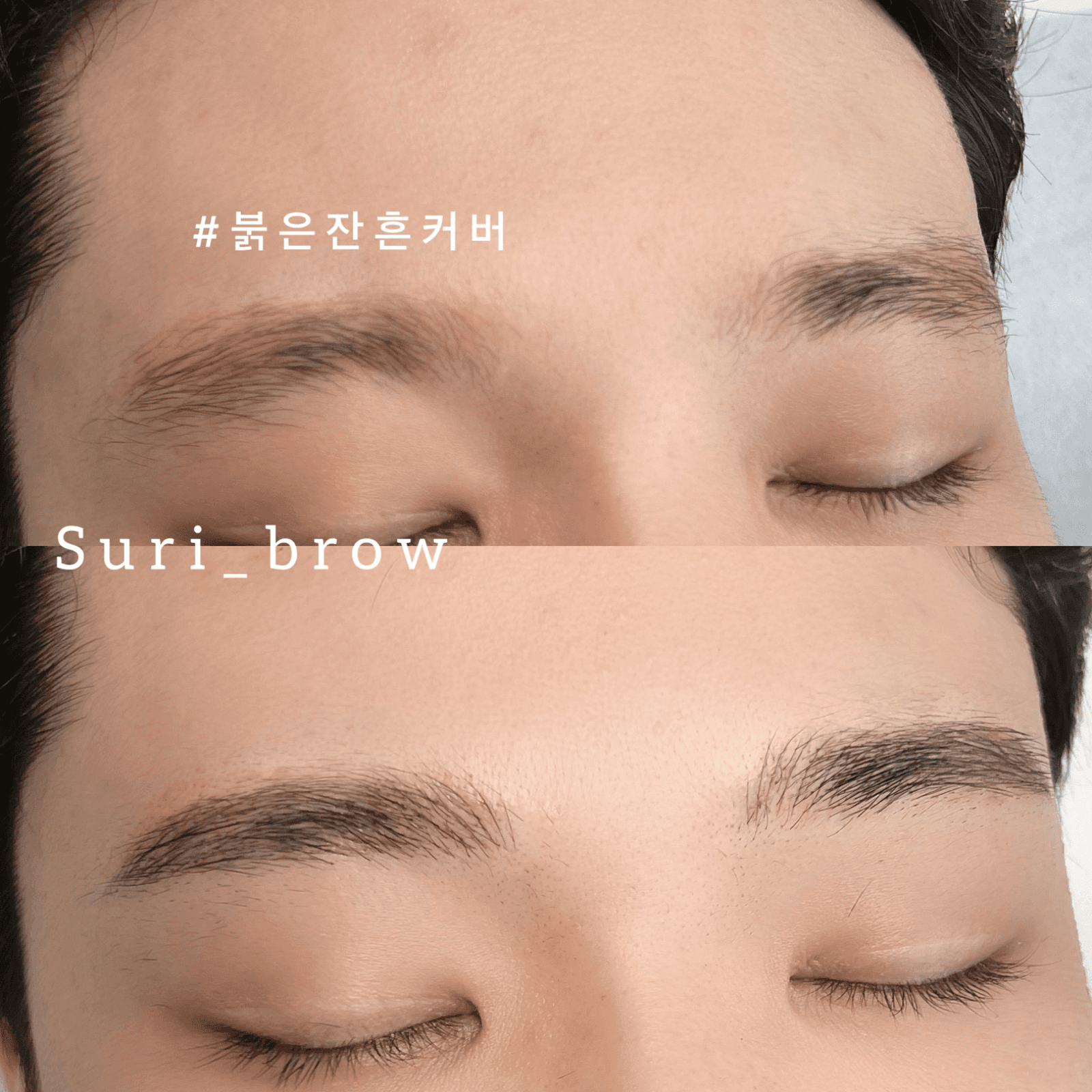 남자눈썹문신 붉은잔흔 사례
