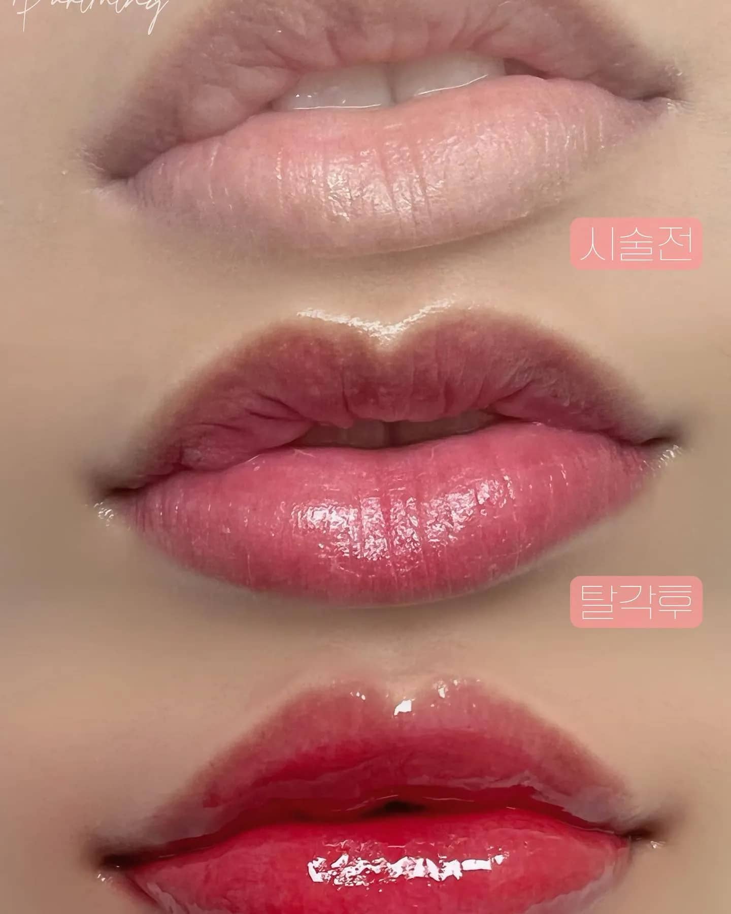 탈각 후 는 꼭 봐주세요!