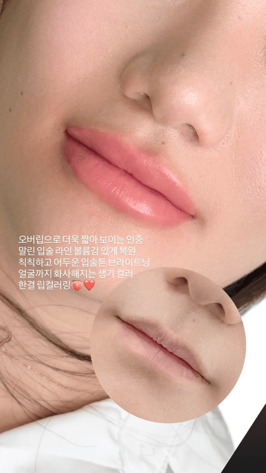 오버립으로 인중까지 교정 완료