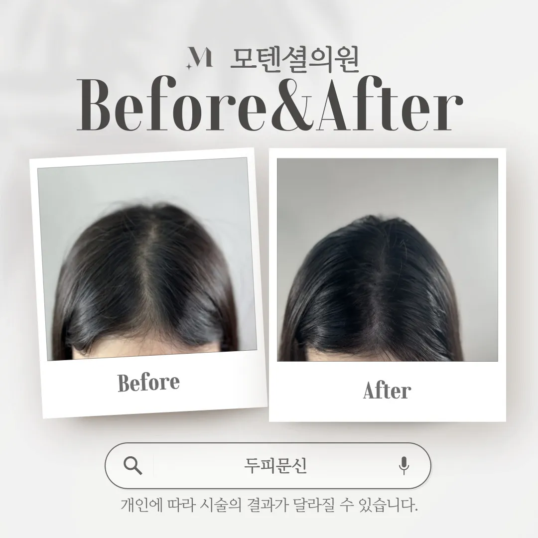 여자 앞 가르마 두피문신