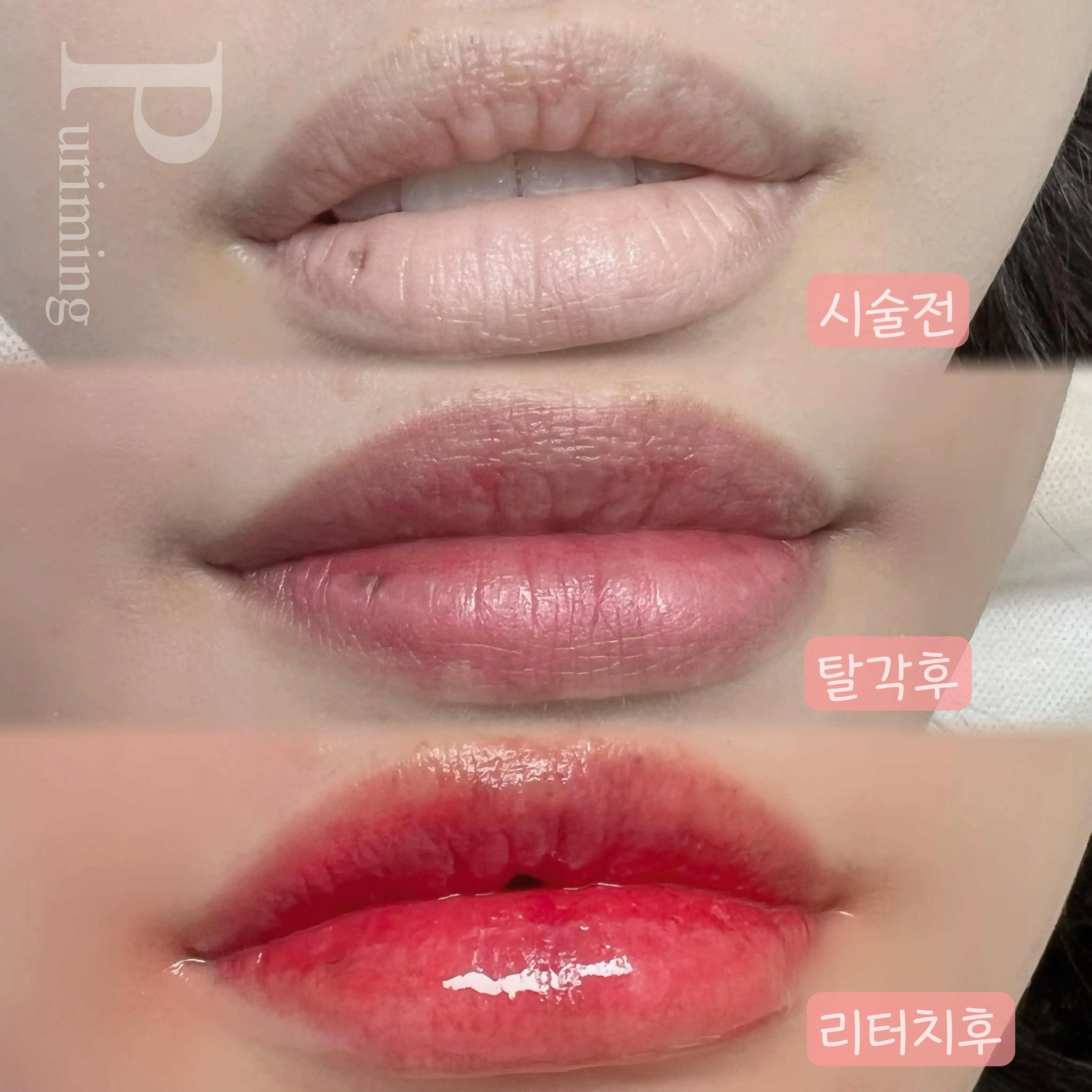 탈각 후 사진은 확인,또 확인 하세요! :) 입술문신은 탈각 후 가 중요해요✌️