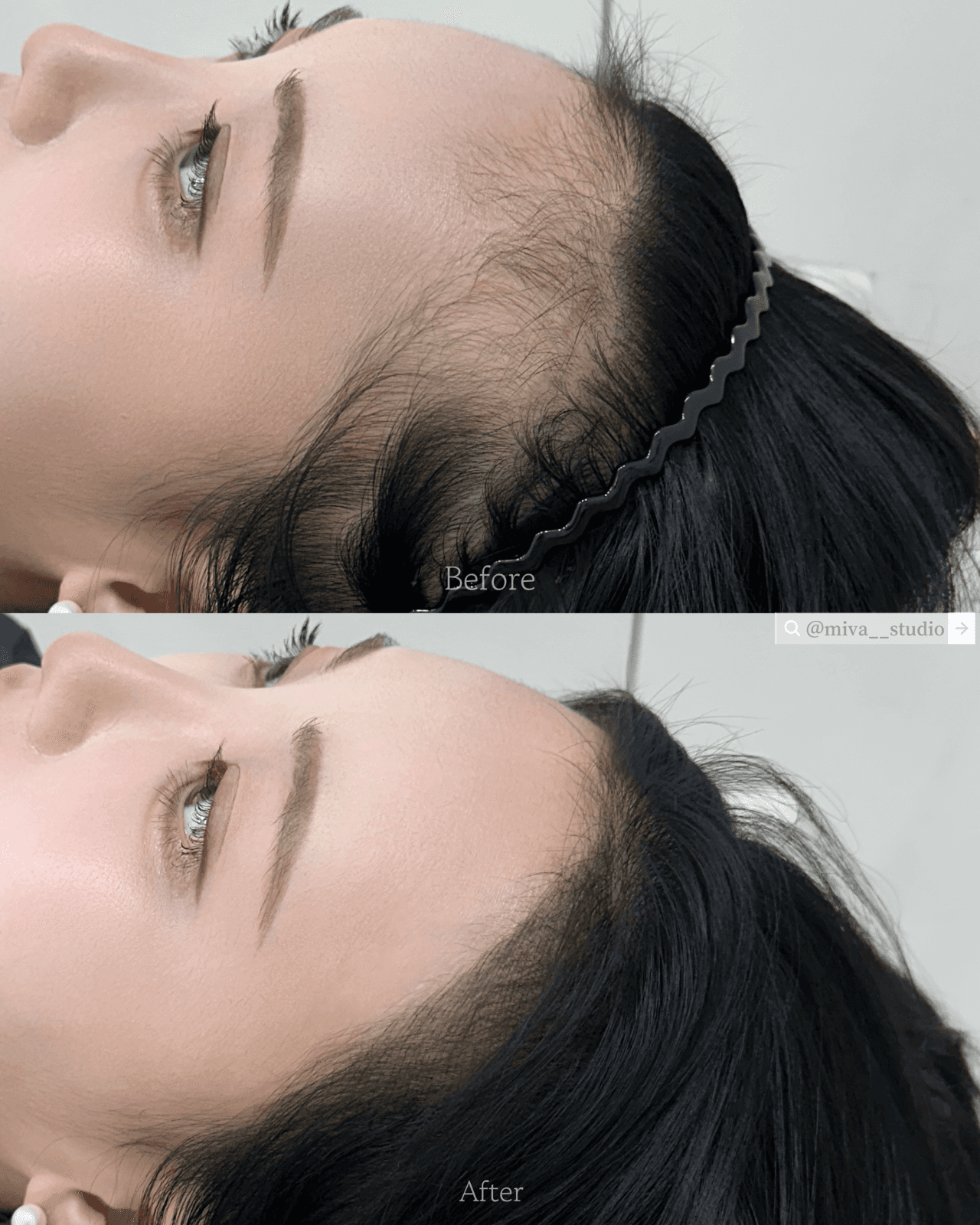둥근이마 헤어라인🖤