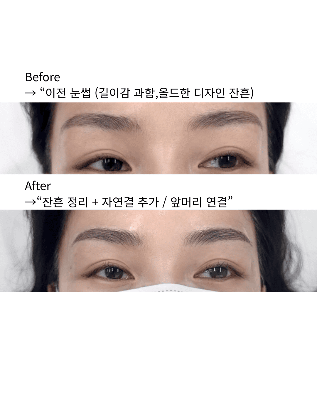 잔흔커버 콤보시술