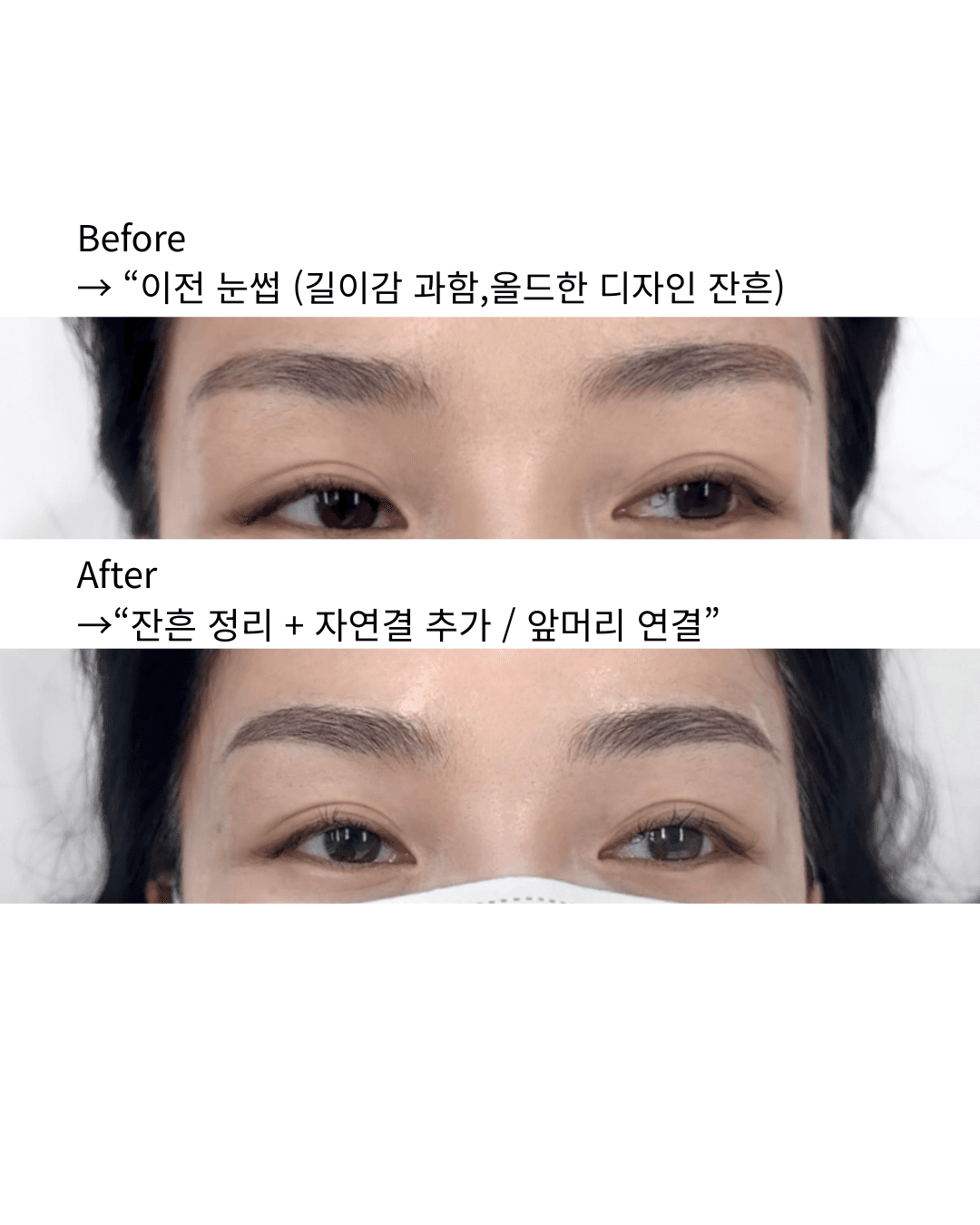 잔흔커버 콤보시술
