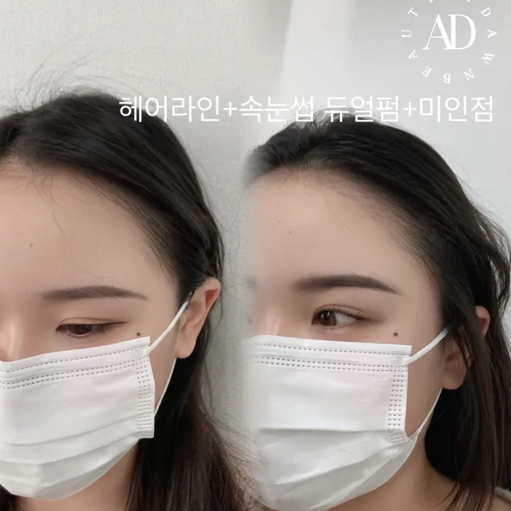 자연스럽게 이마커버
