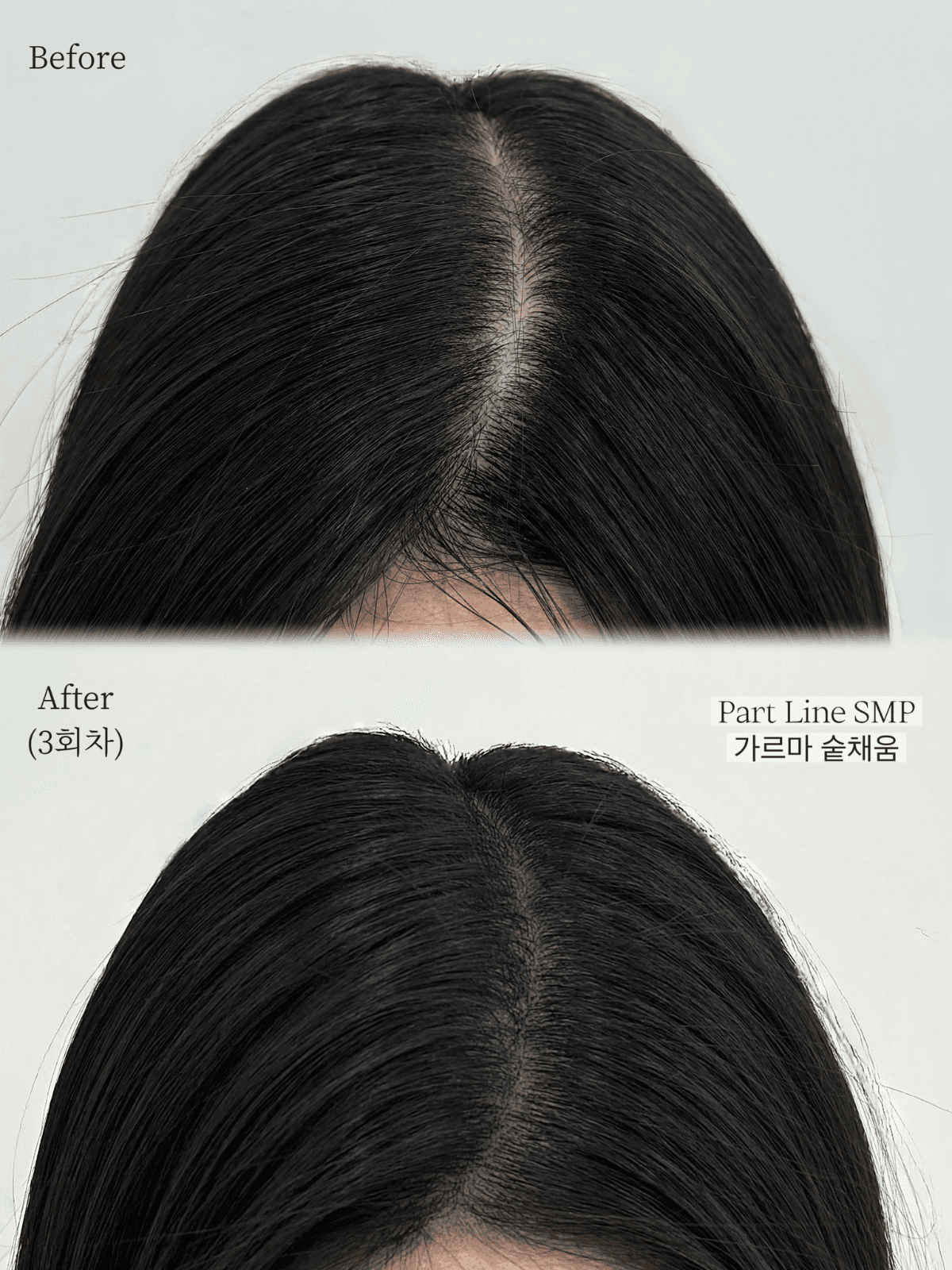 SMP(가르마+정수리) 3회