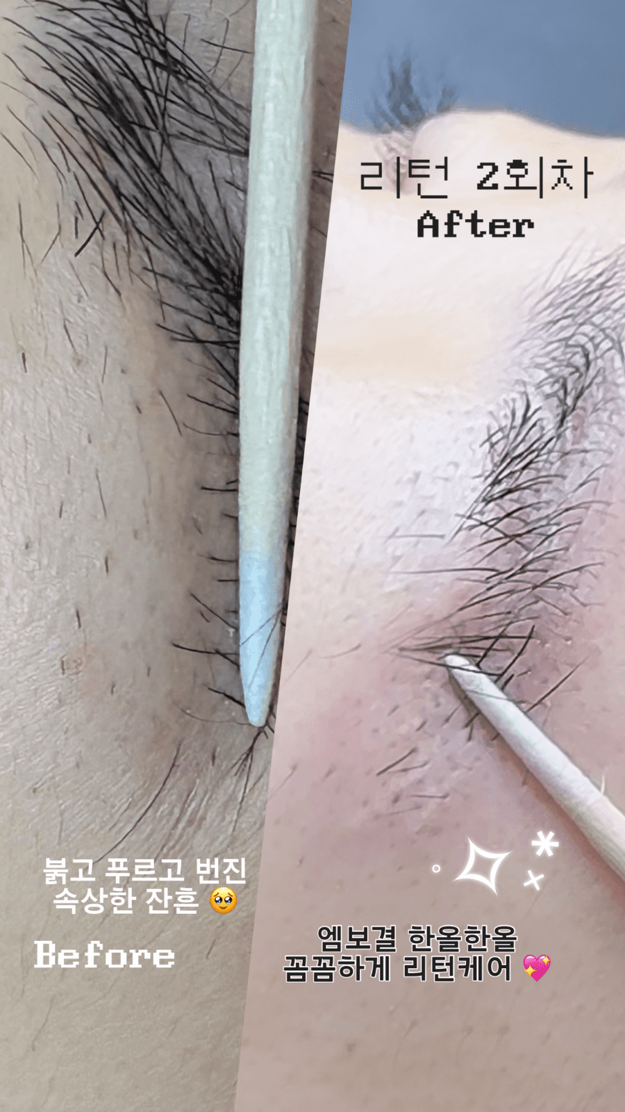 잔흔제거(리턴세럼)